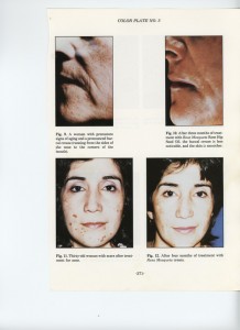 rosehip oil on acne scars